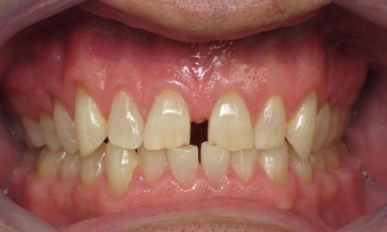 Porcelain-Veneers-Before-Image