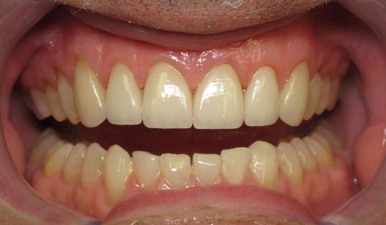 Porcelain-Veneers-After-Image