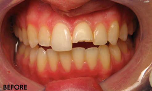 Cosmetic-Bonding-1-Before-Image