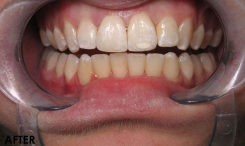 Cosmetic-Bonding-3-After-Image