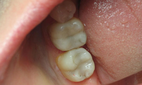 Cosmetic-Bonding-2-After-Image