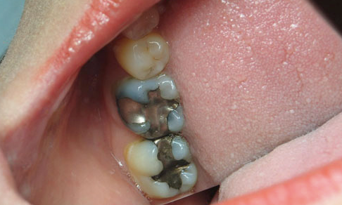 Cosmetic-Bonding-2-Before-Image